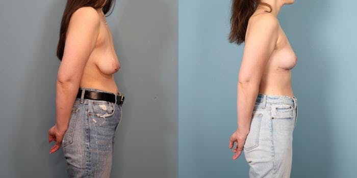 Breast Lift Before & After Gallery - Patient 308464 - Image 3