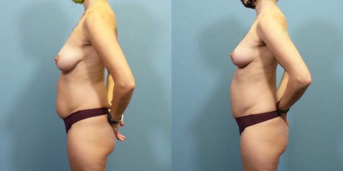 Breast Lift Before & After Gallery - Patient 277056 - Image 1
