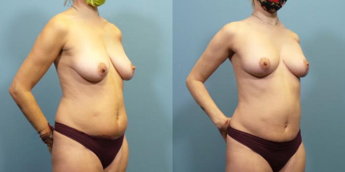 Breast Lift Before & After Gallery - Patient 277056 - Image 2