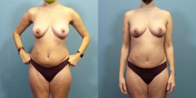 Breast Lift Before & After Gallery - Patient 277056 - Image 3