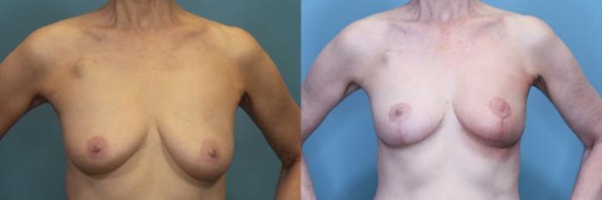 Breast Lift Before & After Gallery - Patient 237698 - Image 1