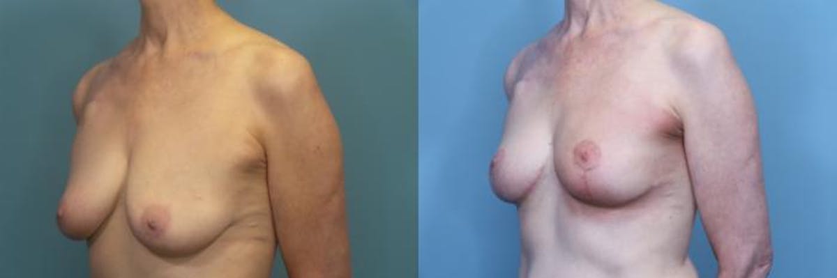 Breast Lift Before & After Gallery - Patient 237698 - Image 2