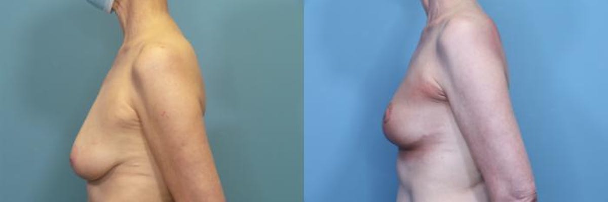 Breast Lift Before & After Gallery - Patient 237698 - Image 3