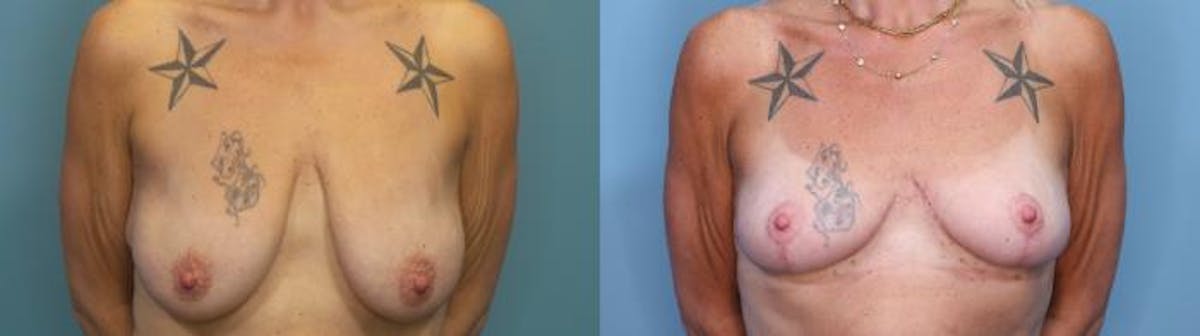 Breast Lift Before & After Gallery - Patient 193180 - Image 1