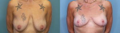Breast Lift Before & After Gallery - Patient 193180 - Image 1