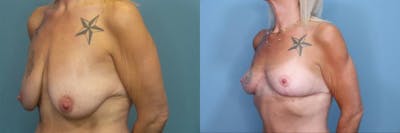 Breast Lift Before & After Gallery - Patient 193180 - Image 2