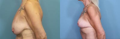 Breast Lift Before & After Gallery - Patient 193180 - Image 3