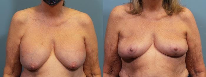 Breast Lift Before & After Gallery - Patient 346659 - Image 1