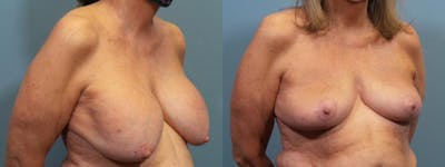 Breast Lift Before & After Gallery - Patient 346659 - Image 2