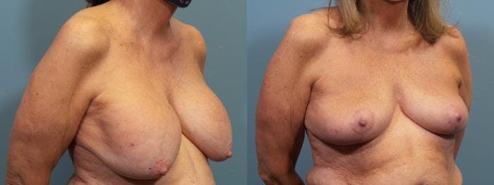 Breast Lift Before & After Gallery - Patient 346659 - Image 2