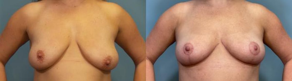 Breast Lift Before & After Gallery - Patient 914150 - Image 1