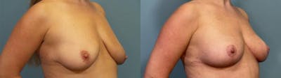 Breast Lift Before & After Gallery - Patient 914150 - Image 2