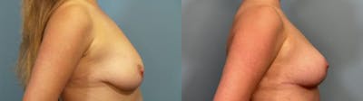 Breast Lift Before & After Gallery - Patient 914150 - Image 3