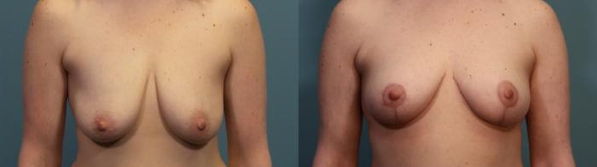 Breast Lift Before & After Gallery - Patient 270654 - Image 1