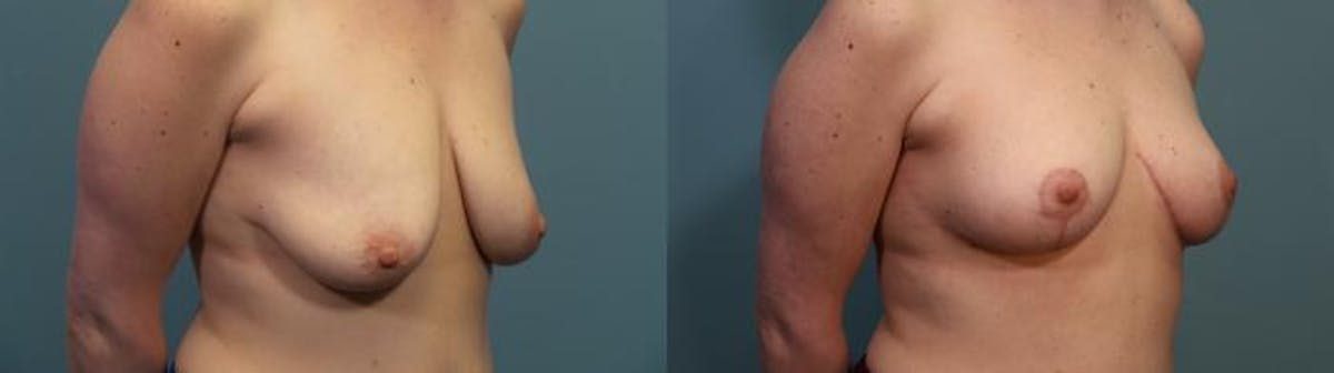 Breast Lift Before & After Gallery - Patient 270654 - Image 2
