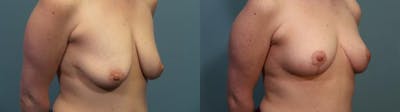 Breast Lift Before & After Gallery - Patient 270654 - Image 2