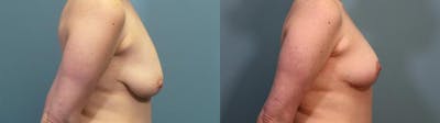 Breast Lift Before & After Gallery - Patient 270654 - Image 3