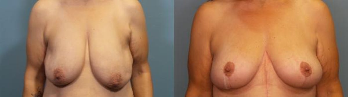 Breast Lift Before & After Gallery - Patient 278159 - Image 1