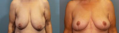 Breast Lift Before & After Gallery - Patient 278159 - Image 1