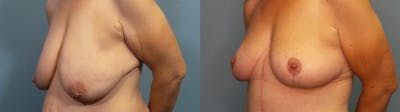 Breast Lift Before & After Gallery - Patient 278159 - Image 2