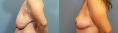 Breast Lift Before & After Gallery - Patient 278159 - Image 3