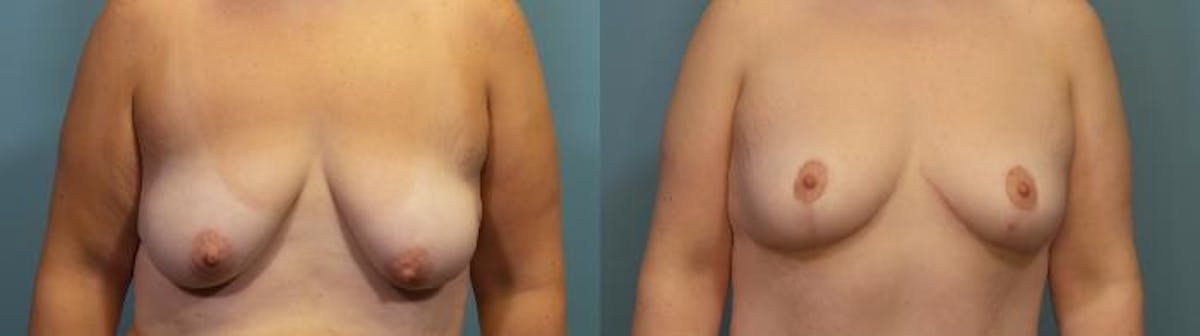 Breast Lift Before & After Gallery - Patient 130812 - Image 1