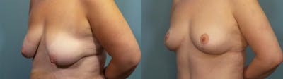Breast Lift Before & After Gallery - Patient 130812 - Image 2