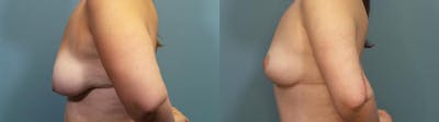 Breast Lift Before & After Gallery - Patient 130812 - Image 3