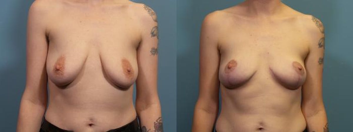 Breast Lift Before & After Gallery - Patient 376570 - Image 1