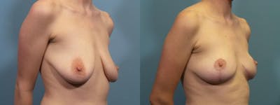 Breast Lift Before & After Gallery - Patient 376570 - Image 2