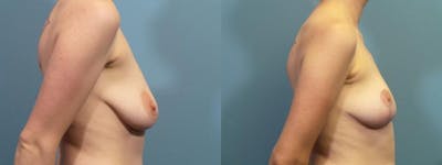Breast Lift Before & After Gallery - Patient 376570 - Image 3