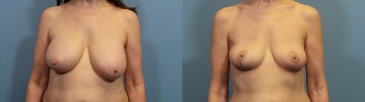 Breast Lift Before & After Gallery - Patient 308359 - Image 1