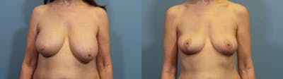 Breast Lift Before & After Gallery - Patient 308359 - Image 1