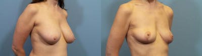 Breast Lift Before & After Gallery - Patient 308359 - Image 2