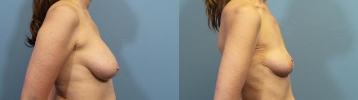 Breast Lift Before & After Gallery - Patient 308359 - Image 3