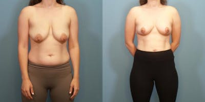 Breast Lift Before & After Gallery - Patient 283999 - Image 1