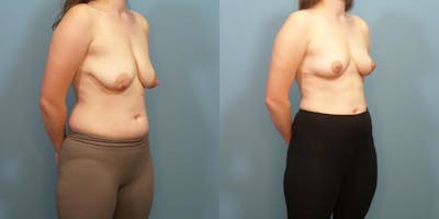 Breast Lift Before & After Gallery - Patient 283999 - Image 2