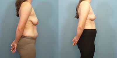 Breast Lift Before & After Gallery - Patient 283999 - Image 3