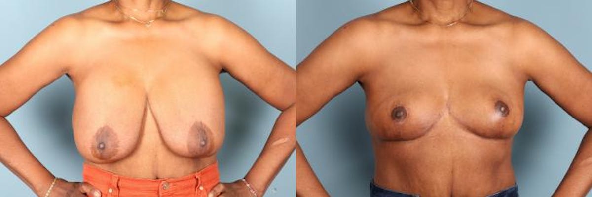 Breast Lift Before & After Gallery - Patient 206961 - Image 1