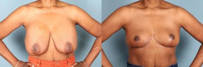 Breast Lift Before & After Gallery - Patient 206961 - Image 1
