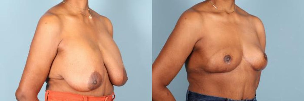 Breast Lift Before & After Gallery - Patient 206961 - Image 2