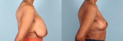 Breast Lift Before & After Gallery - Patient 206961 - Image 3