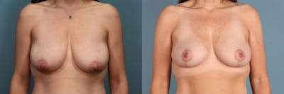 Breast Lift Before & After Gallery - Patient 392845 - Image 1