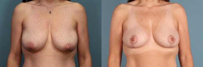 Breast Lift Before & After Gallery - Patient 392845 - Image 1