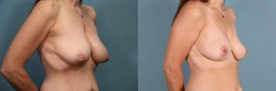 Breast Lift Before & After Gallery - Patient 392845 - Image 2