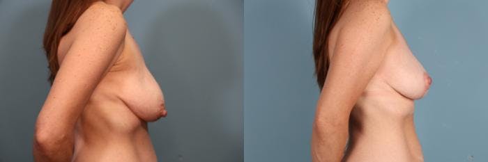 Breast Lift Before & After Gallery - Patient 392845 - Image 3