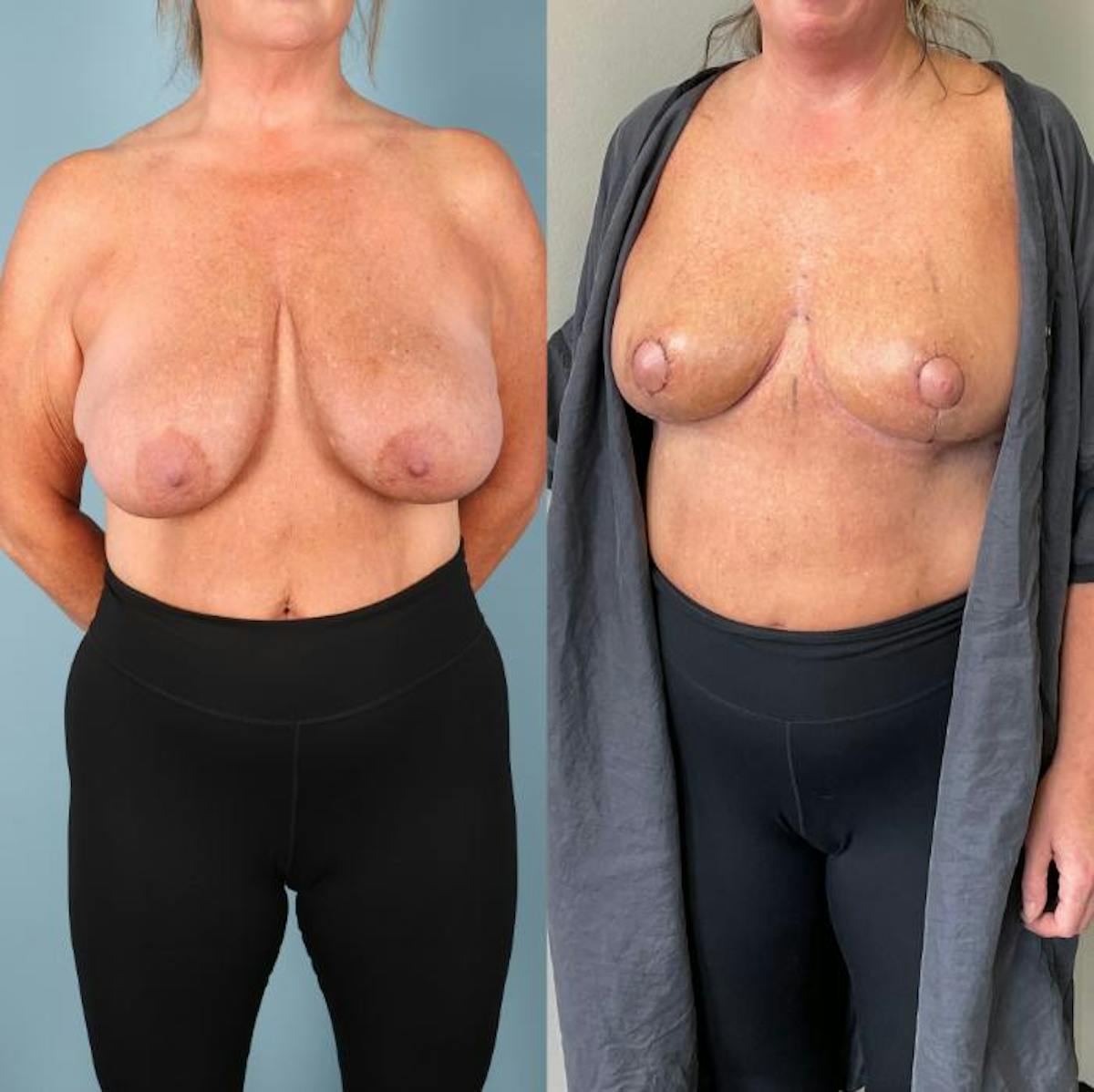 Breast Lift Before & After Gallery - Patient 324324 - Image 1