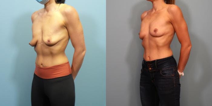 Breast Lift Before & After Gallery - Patient 204118 - Image 1