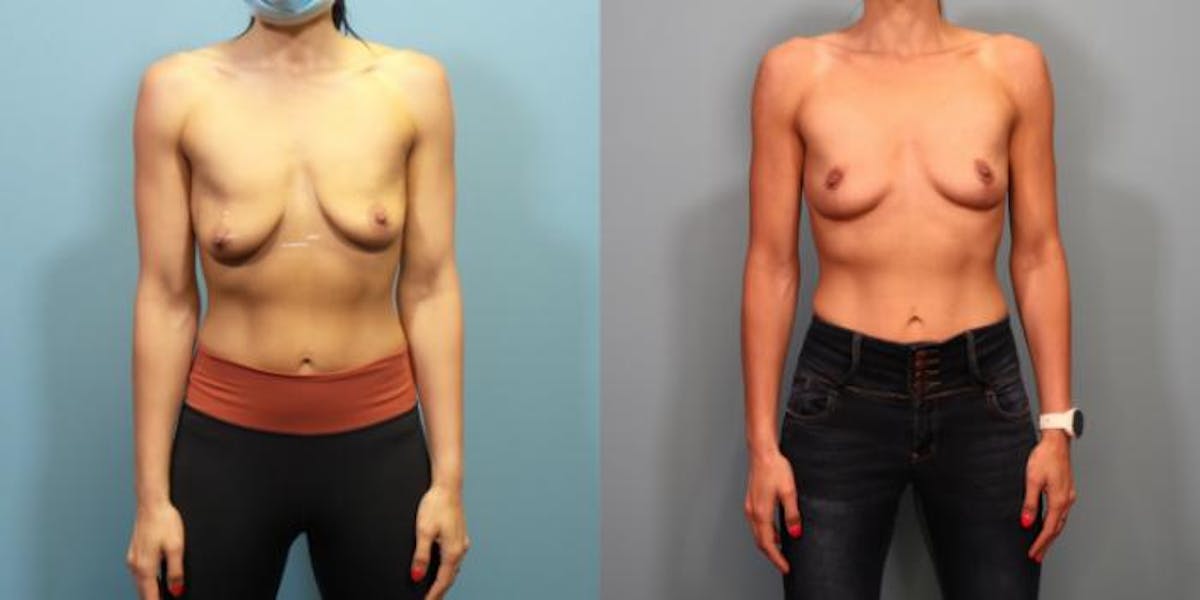 Breast Lift Before & After Gallery - Patient 204118 - Image 2
