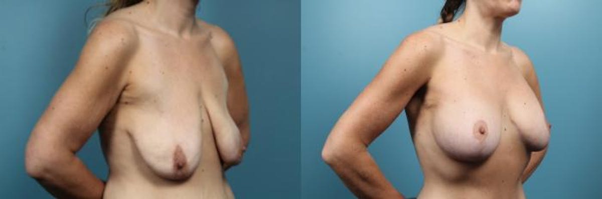 Breast Lift Before & After Gallery - Patient 783435 - Image 2